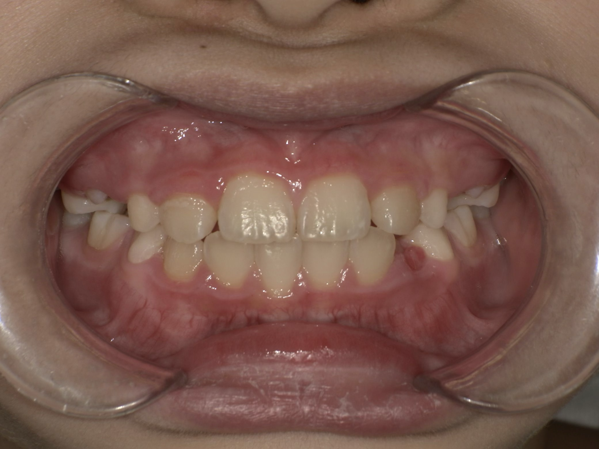 Pediatric After